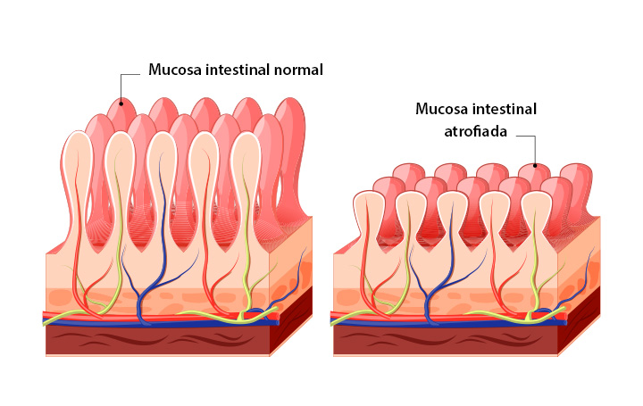 Dietoterapia para as doenças do sistema gastrointestinal: esôfago ...